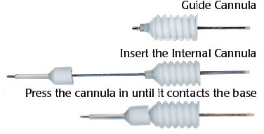 Metal needle (left) and plastic cannula (center: metal guide